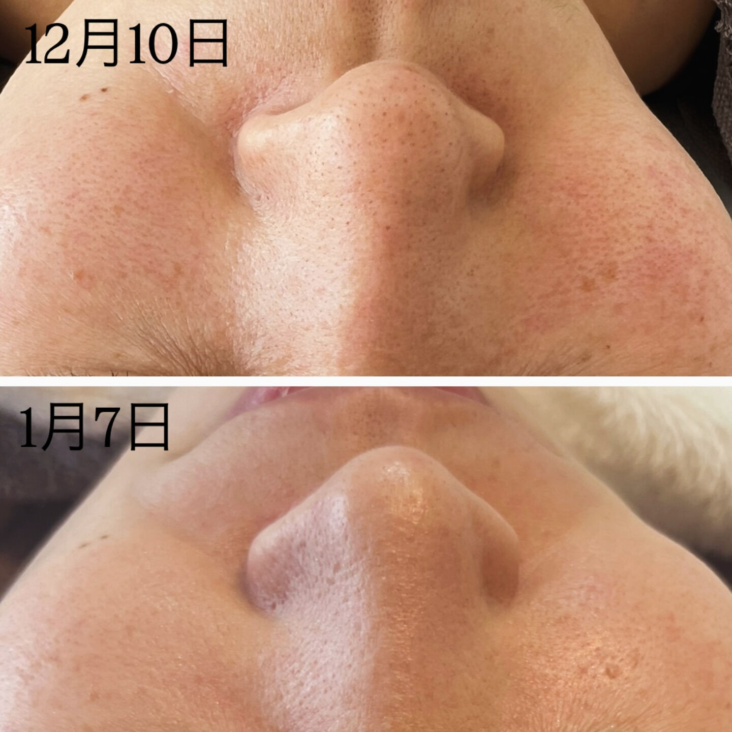 毛穴パックしちゃってる方いますか？🥺