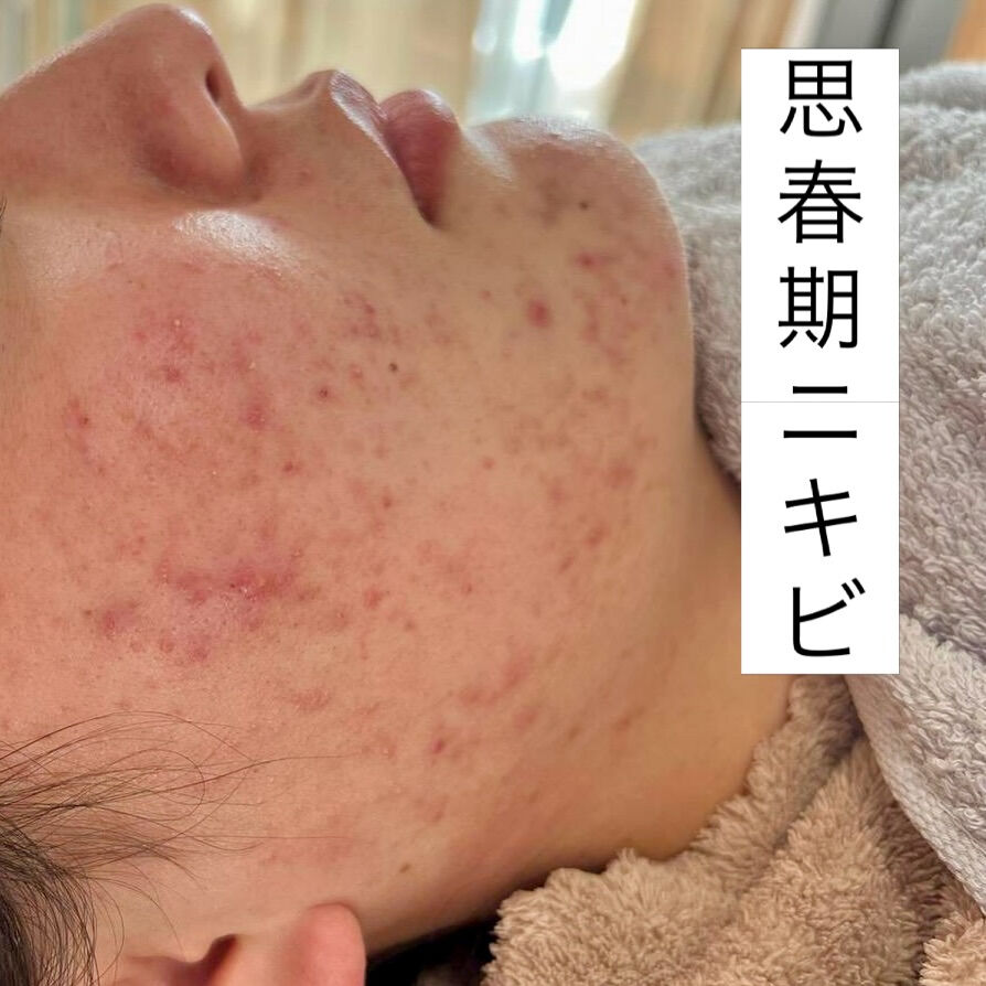 思春期ニキビ→ホルモンの急増による皮脂過多が主原因