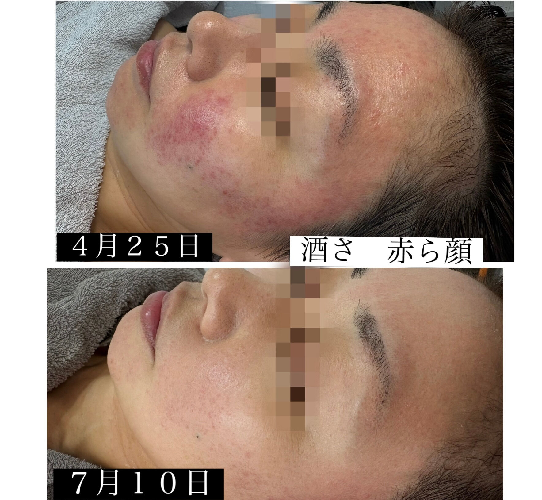 酒さ、赤ら顔でお悩みだったお客様