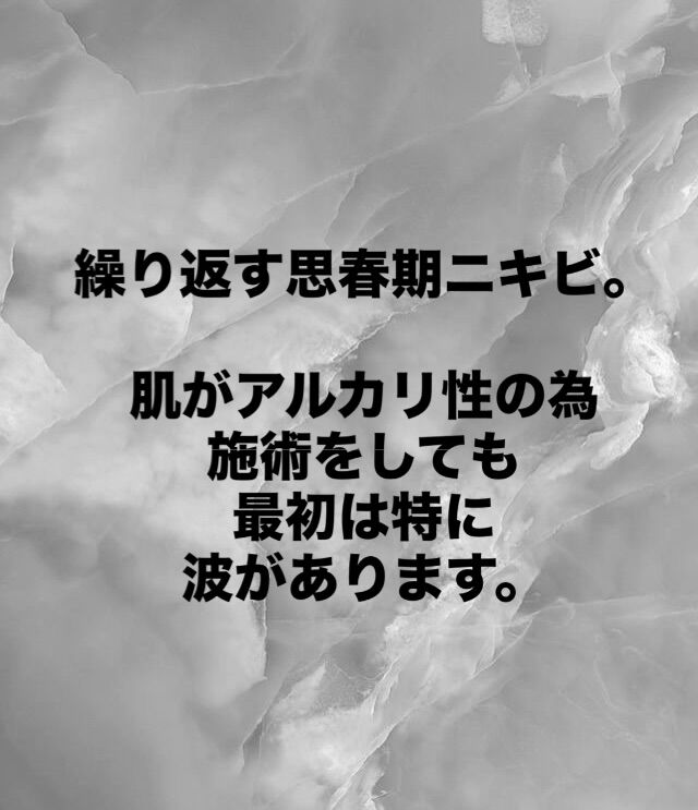 #思春期ニキビ#にきび#肌荒れ#乾燥肌#脱ステ 